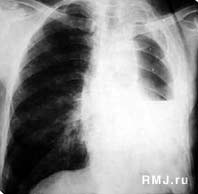 Первые признаки и лечение пневмонии у новорожденных