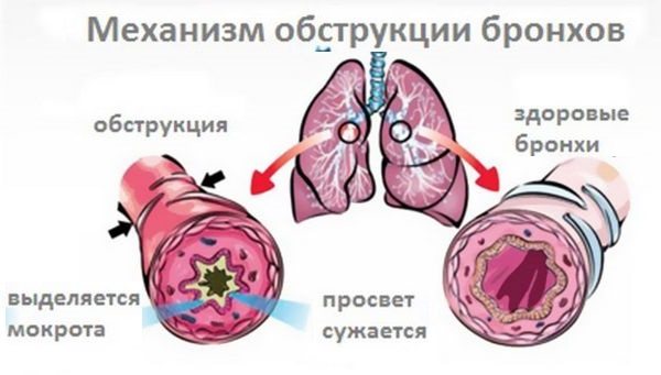 Как лечить бронхит у детей: эффективные методы в домашних условиях
