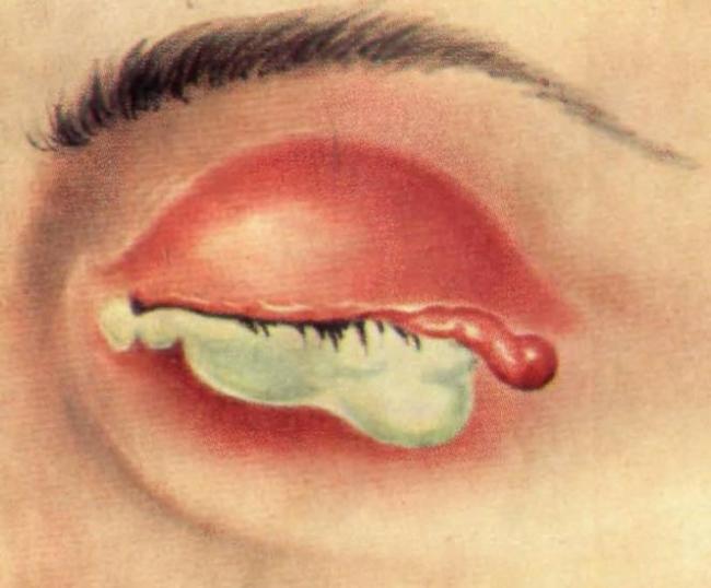 Вирусный конъюнктивит и его терапия: капли, мази, народное лечение