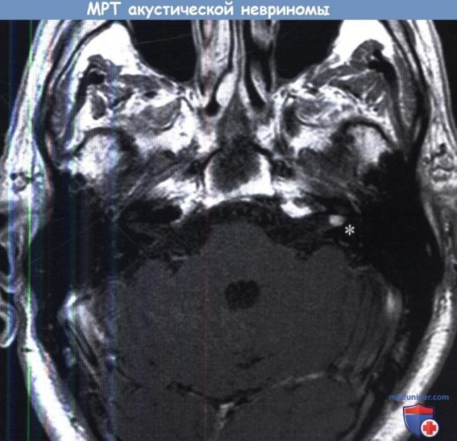Симптомы и лечение нейросенсорной тугоухости 1-4 степеней, восстановится ли слух