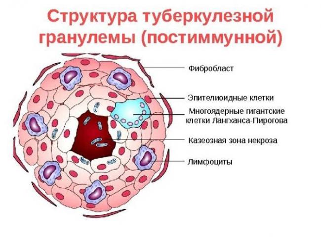 Открытая форма туберкулеза легких