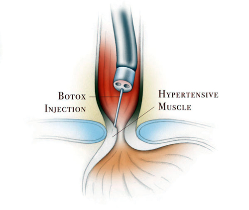 Ахалазия пищевода