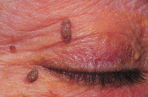 Папиллома на веке удаление народными средствами