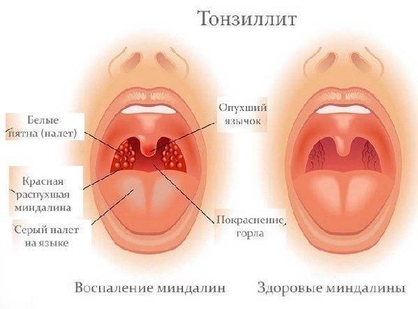 Лечение тонзиллита народными средствами: самые эффективные методы