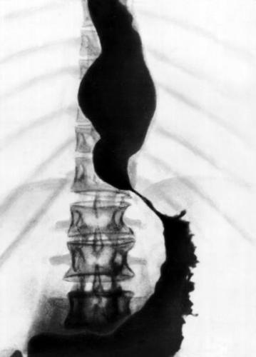 Недостаточность кардии желудка – причины, симптомы ахалазии кардии пищевода