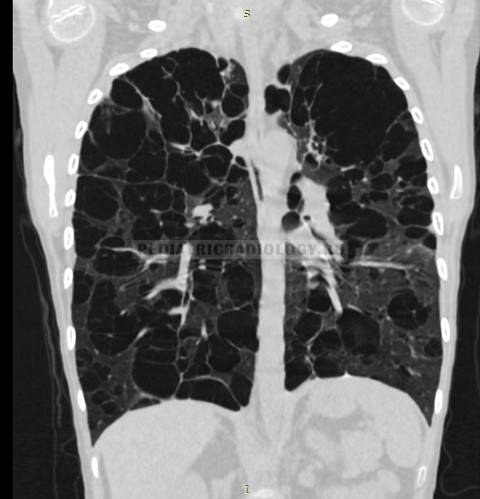 Очаг в лёгком