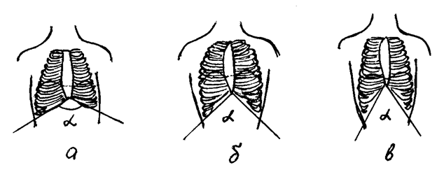 Ладьевидная грудная клетка