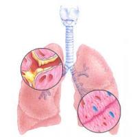 Показатели средней продолжительности жизни при пневмосклерозе легких