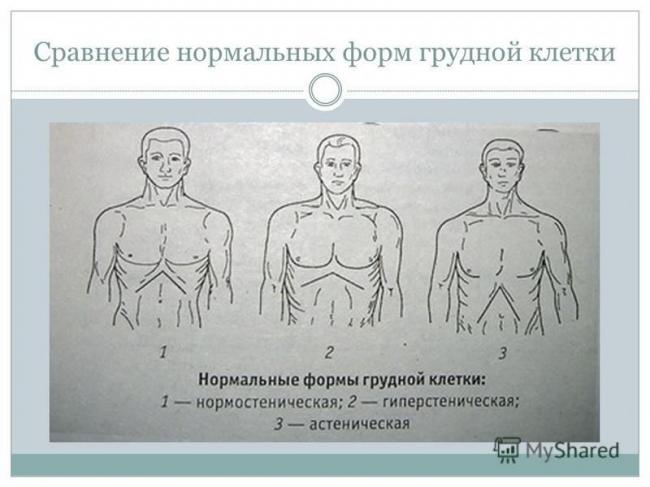 Пороки развития грудной клетки