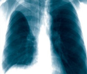 Ателектаз легкого