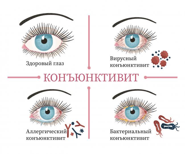 Лечение конъюнктивита глаз у детей до 1 года препаратами и народными методами