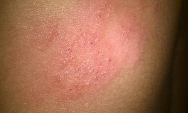 Эконазол аналоги. цены на аналоги в аптеках