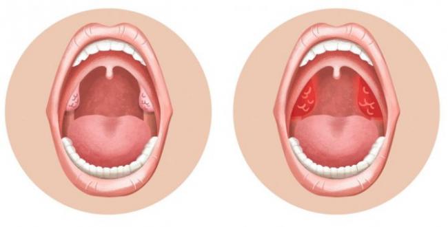 Воспаление гланд: методы лечения