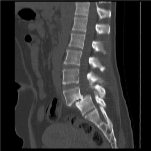 Спондилолистз смещение позвонков пояснично-крестцового отдела позвоночника симптомы