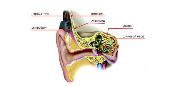 Нейросенсорная тугоухость – лечится или нет, можно ли остановить потерю слуха?