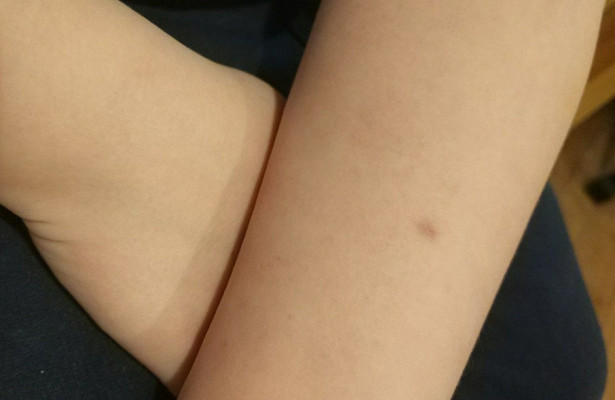 Диаскинтест