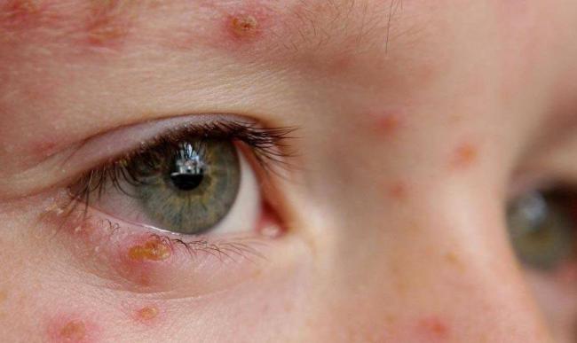 Бактериальный конъюнктивит глаз лечение у взрослых капли