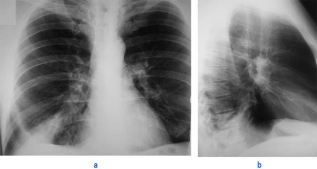 Что делать если не раскрылись лёгкие у младенца? (ателектаз)