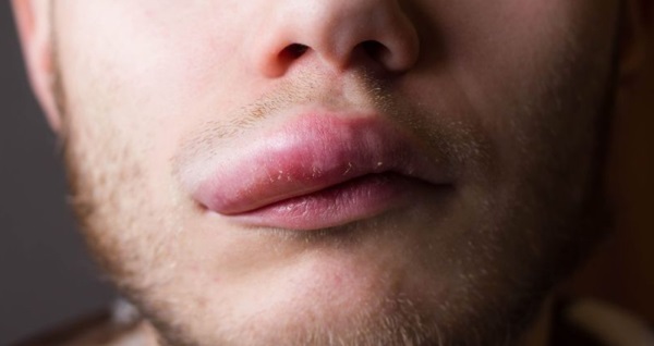 Ангионевротический отек: принципы диагностики и терапии