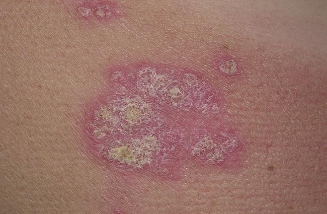 Магнипсор от псориаза: описание и инструкция по применению, особые указания и аналоги