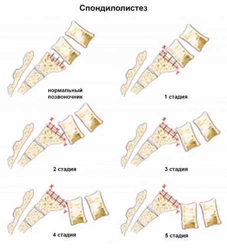 Спондилолистез пояснично-крестцового отдела позвоночника: причины, симптомы и лечение