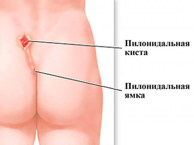 Кокцигодиния — причины болей, симптомы и лечение