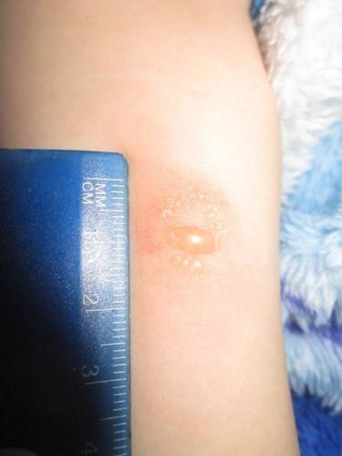 Аллергия на манту у детей и взрослых – миф или реальность?