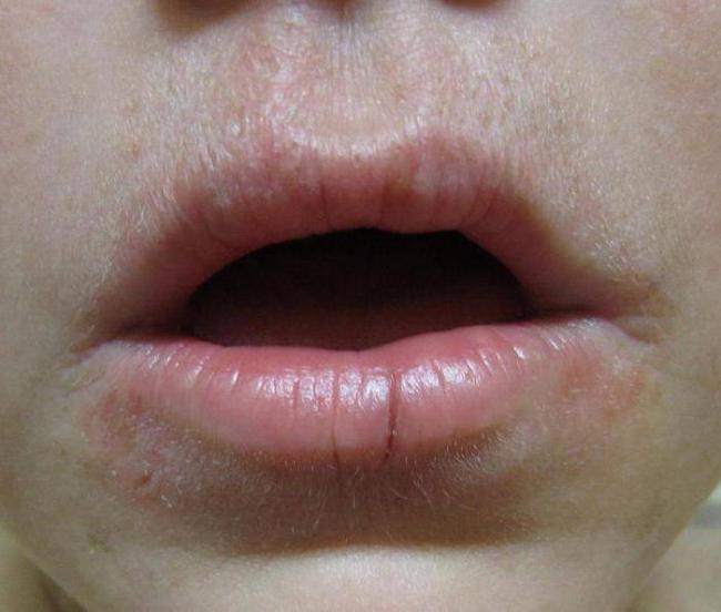 Мазь для наружного применения Акрихин Акридерм - отзывы