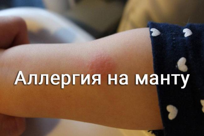 Аллергия на реакцию манту