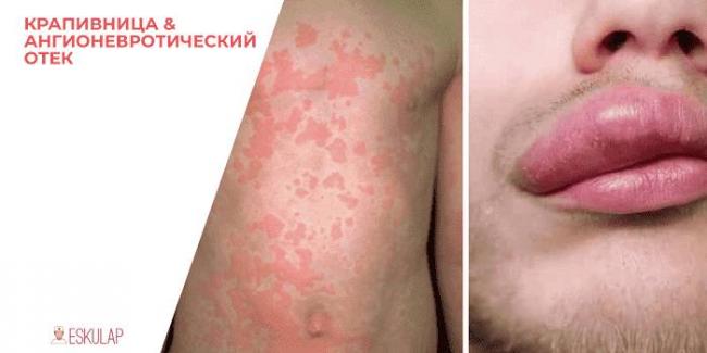 Отек квинке