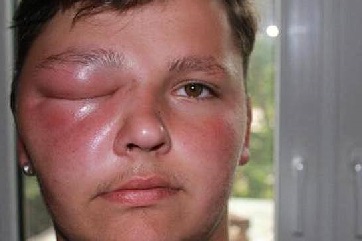 Ангионевротический отек: принципы диагностики и терапии