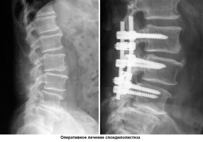 Спондилолистез пояснично-крестцового отдела позвоночника