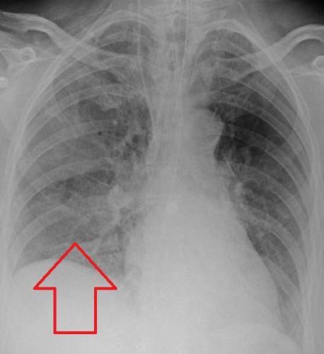 Пневмония у новорождённых — сколько лечится и какие причины?