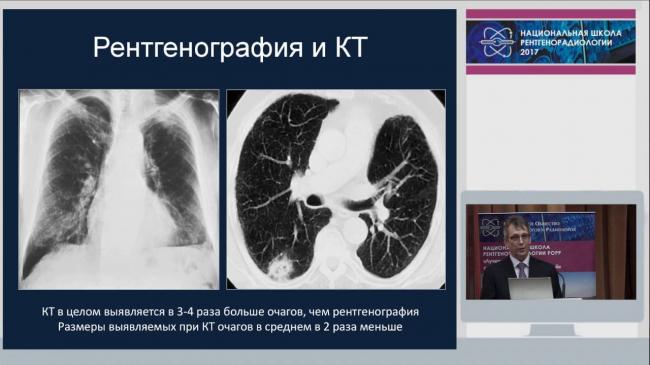 Полиморфные очаги в легких что это