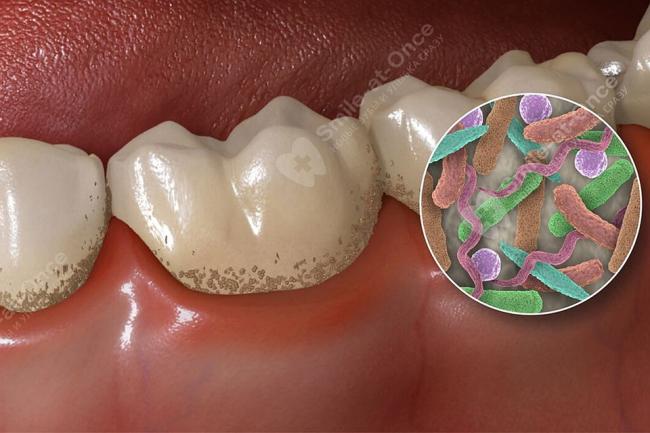 Современный подход к лечению бактериальной инфекции в полости желудка