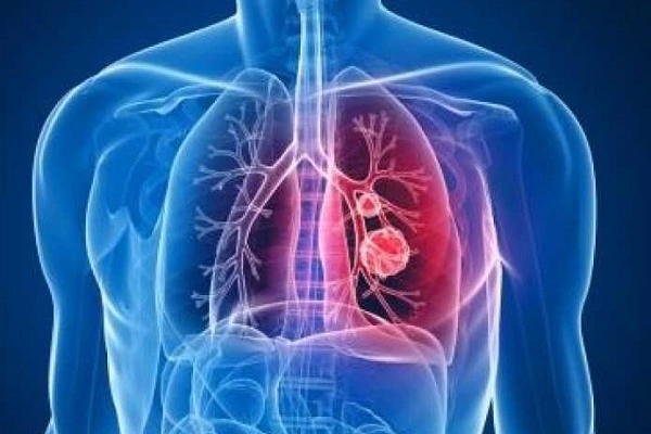 Пневмония у недоношенных детей: сколько лечиться новорожденным, внутриутробная форма