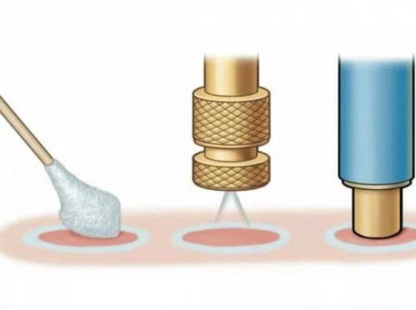 Папиллома на глазу: как удалить папиллому под глазом?