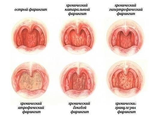 Больно глотать с правой стороны и нет температуры – колющая боль