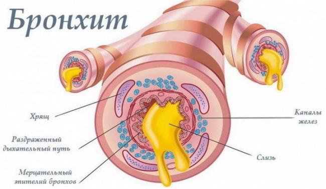 Бронхит у ребенка лечение народными средствами в домашних условиях