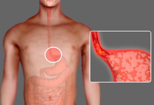 Рацион питания при гастрите с повышенной кислотностью