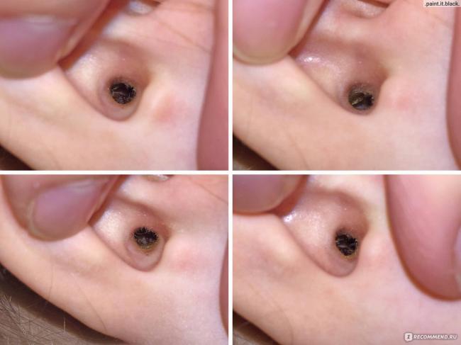 Пробки в ушах у ребенка: что делать, как убрать в домашних условиях