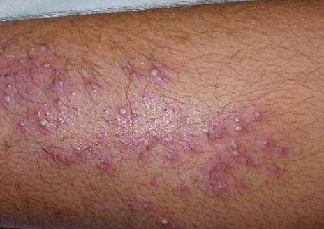 Неоспорин мазь инструкция по применению, аналоги, отзывы Подробнее