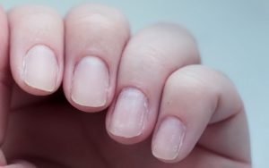 Слоятся, крошатся, ломаются ногти: почему очень тонкие ногти, лечение, что делать в домашних условиях