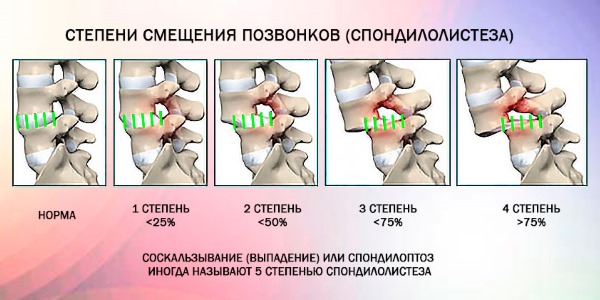 Спондилолистз смещение позвонков пояснично-крестцового отдела позвоночника симптомы