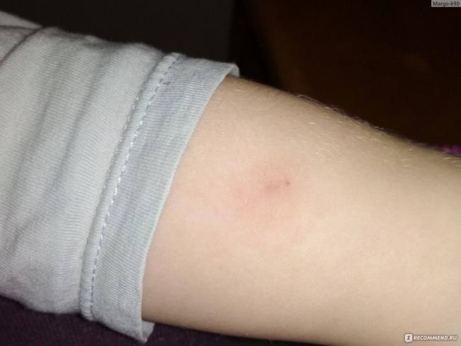 Аллергия на манту у детей и взрослых – миф или реальность?