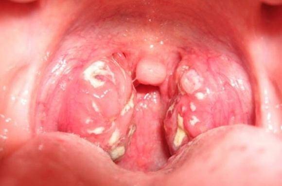 Закаливание горла при хроническом тонзиллите