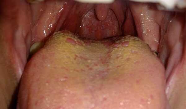 Почему скапливается слизь в носоглотке и как от нее избавиться?