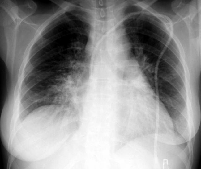 Ателектаз легких: причины, симптомы, лечение, ателектаз легких у детей