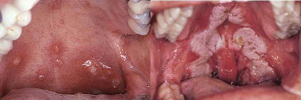 Болит горло с одной стороны: причины