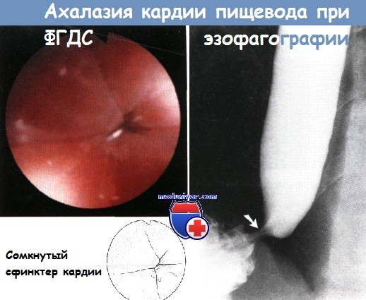 Ахалазия кардии: причины, симптомы, методы лечения
